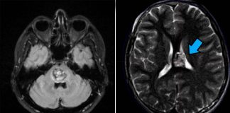 A cavernous angioma affects more than one million Americans and carries a lifetime risk of stroke and seizures