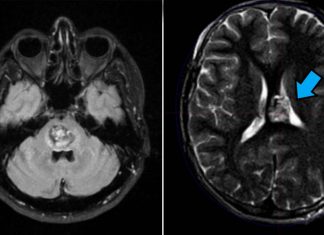 A cavernous angioma affects more than one million Americans and carries a lifetime risk of stroke and seizures