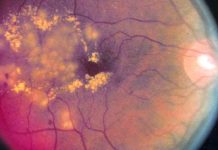 Fenofibrate can reduce the risk of developing proliferative diabetic retinopathy (PDR) and vision-threatening diabetic retinopathy (VTDR)
