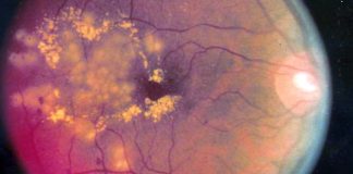 Fenofibrate can reduce the risk of developing proliferative diabetic retinopathy (PDR) and vision-threatening diabetic retinopathy (VTDR)