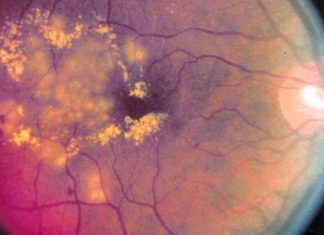 Fenofibrate can reduce the risk of developing proliferative diabetic retinopathy (PDR) and vision-threatening diabetic retinopathy (VTDR)