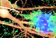 Type 1 interferon is a major driver of cognitive impairment and memory loss in Alzheimer’s disease