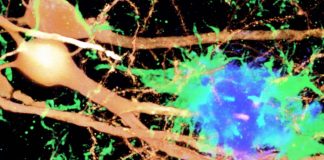 Type 1 interferon is a major driver of cognitive impairment and memory loss in Alzheimer’s disease
