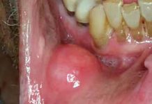 Oral cancers: Lysine-specific demethylase 1 might help limit a tumor’s development and spread