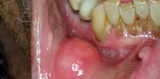 Oral cancers: Lysine-specific demethylase 1 might help limit a tumor’s development and spread