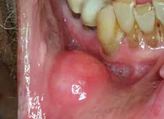 Oral cancers: Lysine-specific demethylase 1 might help limit a tumor’s development and spread