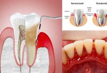 Parodontite: l’RNA a doppio filamento (dsRNA) derivato da batteri o cellule autologhe induce la perdita ossea
