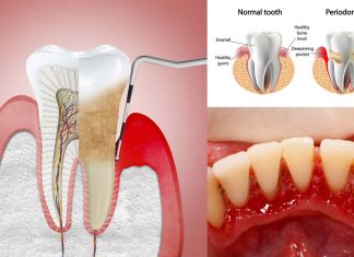 Parodontite: l’RNA a doppio filamento (dsRNA) derivato da batteri o cellule autologhe induce la perdita ossea