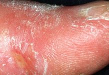 Scleroderma: the concentration of fibroblasts drops dramatically in the tissues