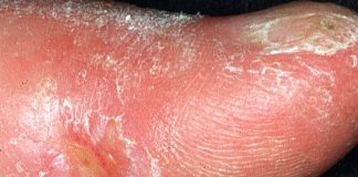 Scleroderma: the concentration of fibroblasts drops dramatically in the tissues
