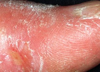 Scleroderma: the concentration of fibroblasts drops dramatically in the tissues
