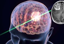 The critical role of genomic profiling in diagnosing and grading brain tumors