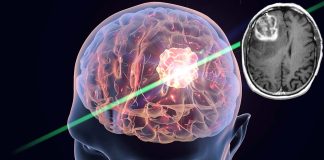 The critical role of genomic profiling in diagnosing and grading brain tumors