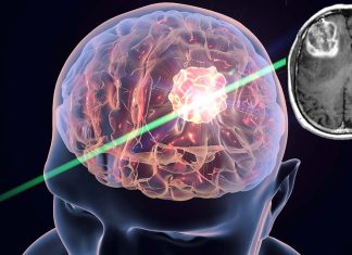 The critical role of genomic profiling in diagnosing and grading brain tumors
