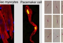 SARS-CoV-2 infection causes dysfunction of human SAN-like pacemaker cells and induces ferroptosis
