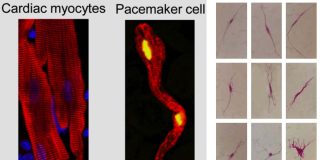 SARS-CoV-2 infection causes dysfunction of human SAN-like pacemaker cells and induces ferroptosis