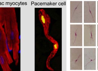 SARS-CoV-2 infection causes dysfunction of human SAN-like pacemaker cells and induces ferroptosis