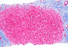 Reduced activation of HSCs limits the associated development of hepatic fibrosis