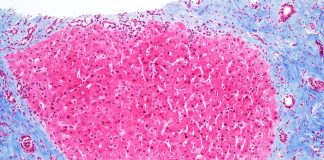 Reduced activation of HSCs limits the associated development of hepatic fibrosis