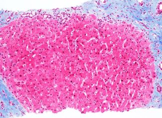 Reduced activation of HSCs limits the associated development of hepatic fibrosis