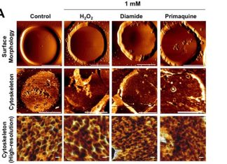 Researchers have for the first time established a link between depressive disorders and mechanical changes in blood cells
