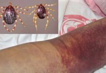 A new wave of Crimean-Congo hemorrhagic fever is spreading in Iraq