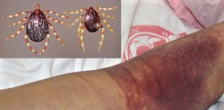 A new wave of Crimean-Congo hemorrhagic fever is spreading in Iraq