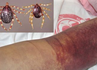 A new wave of Crimean-Congo hemorrhagic fever is spreading in Iraq