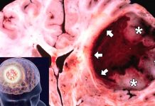 HTL-001 peptide is effective at inhibiting the function of a family of genes responsible for the growth of Glioblastoma Multiforme (GBM)