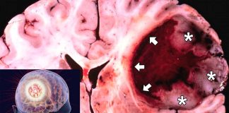 HTL-001 peptide is effective at inhibiting the function of a family of genes responsible for the growth of Glioblastoma Multiforme (GBM)