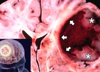 HTL-001 peptide is effective at inhibiting the function of a family of genes responsible for the growth of Glioblastoma Multiforme (GBM)