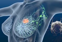Lymph node targeted nanomedicine is the key to treating triple negative breast cancer