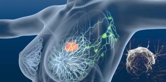 Lymph node targeted nanomedicine is the key to treating triple negative breast cancer