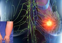 New Wearable robotic sleeve for Lymphedema treatment