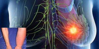 New Wearable robotic sleeve for Lymphedema treatment