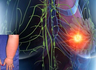New Wearable robotic sleeve for Lymphedema treatment