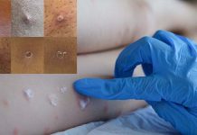 UK – Monkeypox Cases Increasing Fasts In The Last 24 Hours