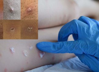 UK – Monkeypox Cases Increasing Fasts In The Last 24 Hours