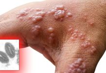 UK Health Authorities Confirms First Case Of Monkeypox Imported From Nigeria