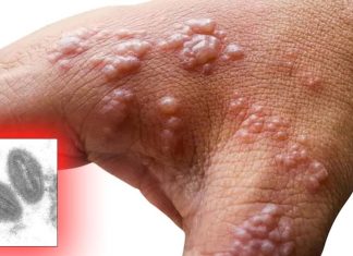 UK Health Authorities Confirms First Case Of Monkeypox Imported From Nigeria