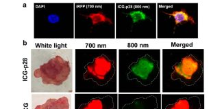 Tumor removal: Near-infrared light fluorescence ICG-p28 can accurately identify tumor margins cutting recurrence