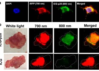 Tumor removal: Near-infrared light fluorescence ICG-p28 can accurately identify tumor margins cutting recurrence