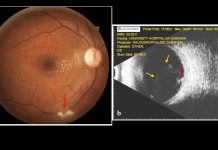 One in 150 Australians have retinal scars caused by the Toxoplasma parasite