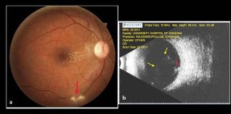 One in 150 Australians have retinal scars caused by the Toxoplasma parasite