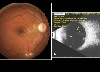 One in 150 Australians have retinal scars caused by the Toxoplasma parasite