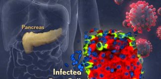 SARS-CoV-2 Directly Infects The Pancreatic Islets And Causes Pancreatic Inflammation