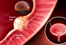 New urine test for bladder cancer