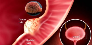 New urine test for bladder cancer