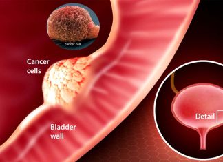 New urine test for bladder cancer