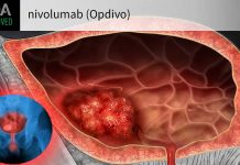 The immunotherapy nivolumab after surgery helped reduce cancer recurrence in patients with urothelial cancer of the bladder